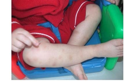 نقص الصفائح الدموية عند الاطفال